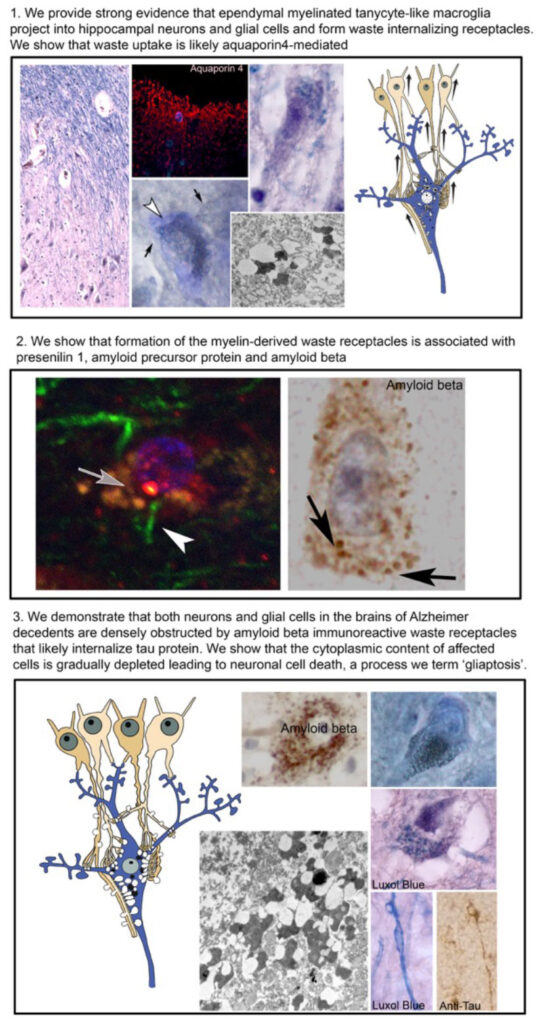 infographic on alzheimers research